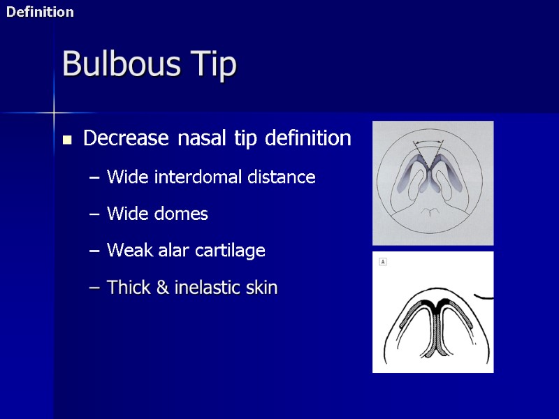 Decrease nasal tip definition  Wide interdomal distance  Wide domes  Weak alar